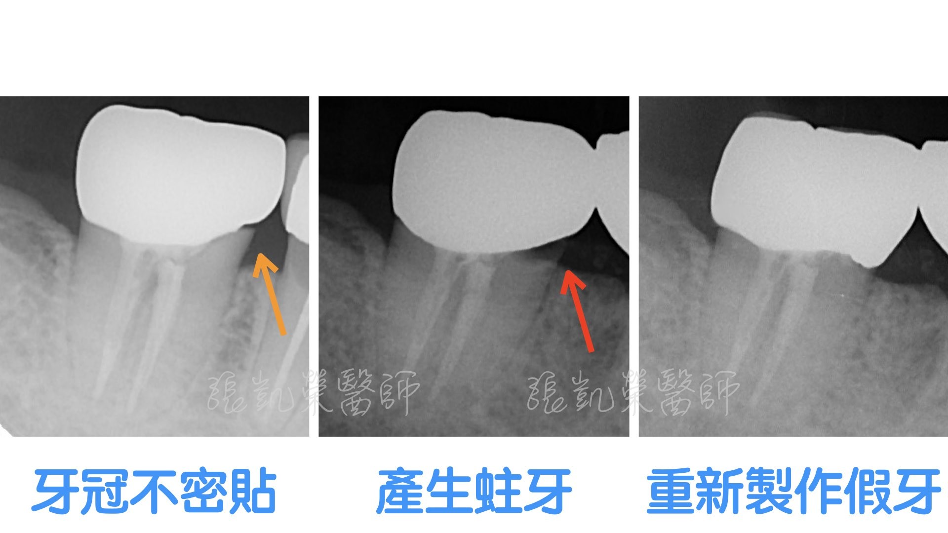 假牙不密貼該怎麼處理？part I :牙齒組織損傷仍可修復
